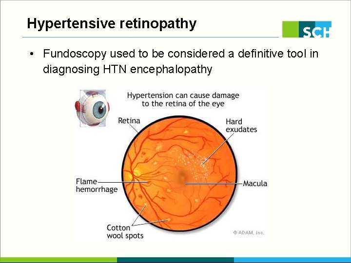 Hypertensive retinopathy • Fundoscopy used to be considered a definitive tool in diagnosing HTN