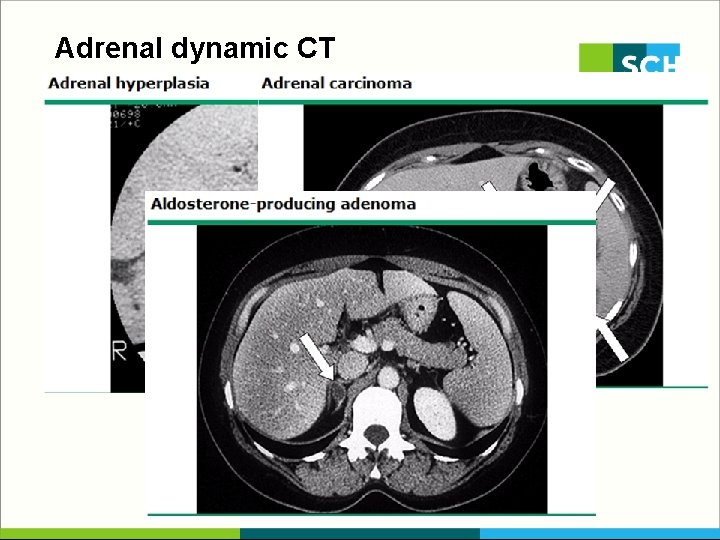 Adrenal dynamic CT 