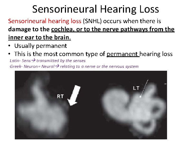 Sensorineural Hearing Loss Sensorineural hearing loss (SNHL) occurs when there is damage to the