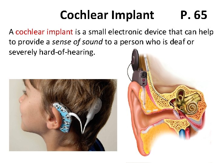 Cochlear Implant P. 65 A cochlear implant is a small electronic device that can