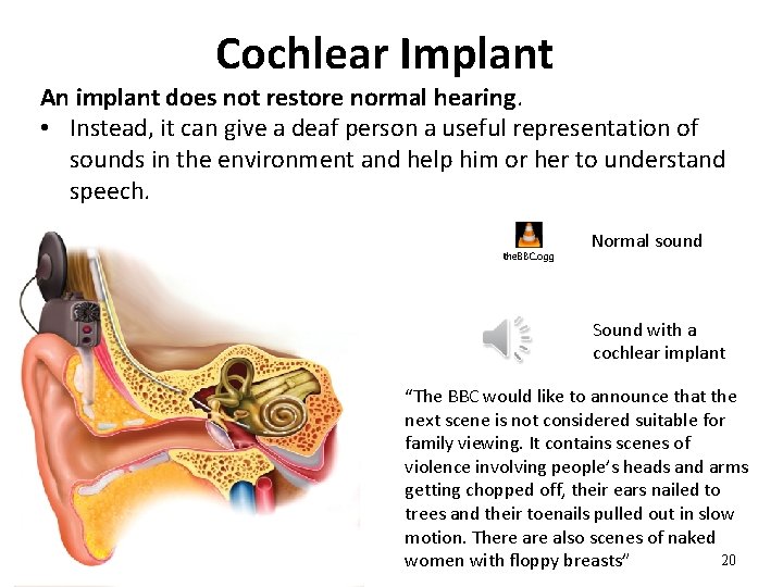 Cochlear Implant An implant does not restore normal hearing. • Instead, it can give