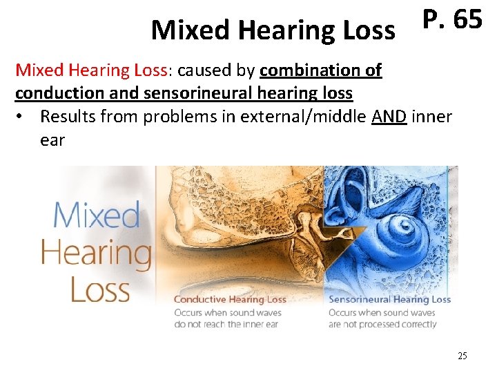 P. 65 Mixed Hearing Loss: caused by combination of conduction and sensorineural hearing loss