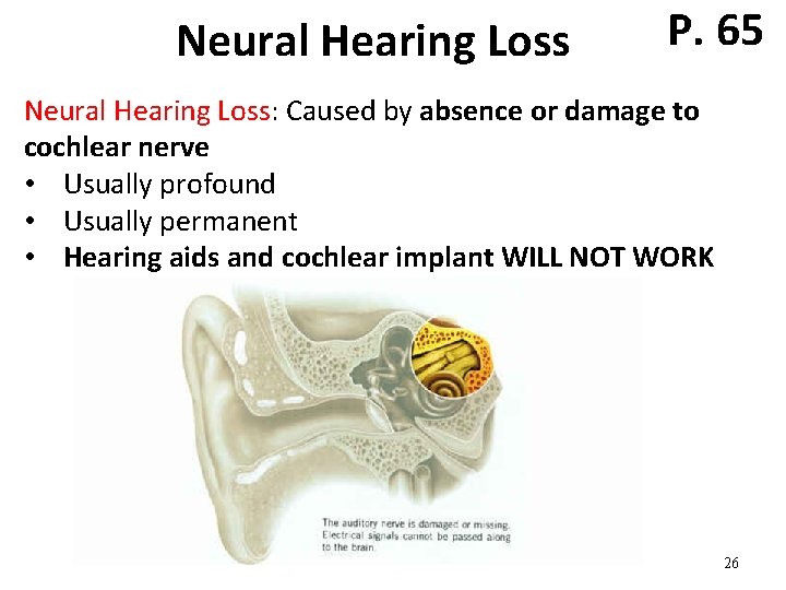 Neural Hearing Loss P. 65 Neural Hearing Loss: Caused by absence or damage to