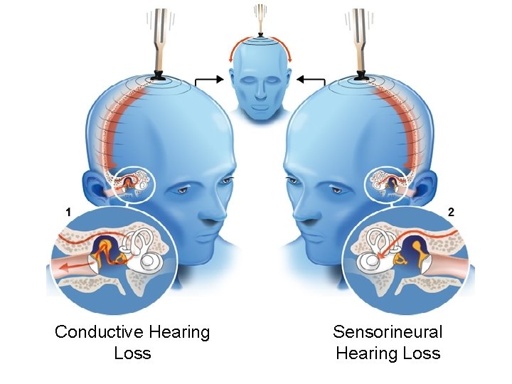 Conductive Hearing Loss Sensorineural Hearing Loss 