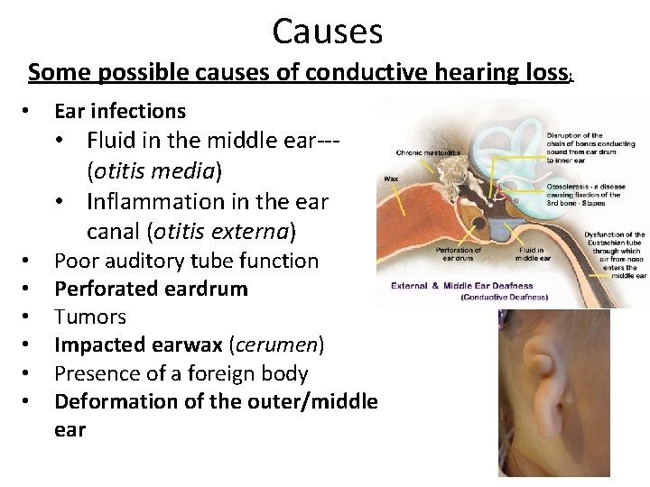 Causes Some possible causes of conductive hearing loss: • Ear infections • Fluid in