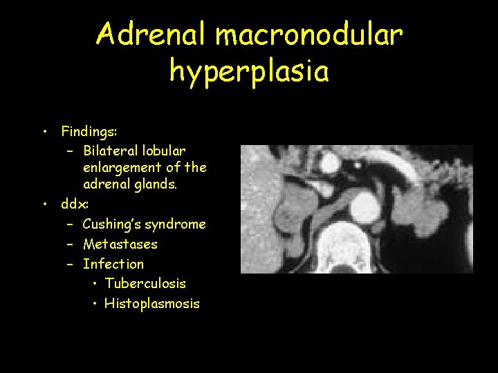 Adrenal macronodular hyperplasia • Findings: – Bilateral lobular enlargement of the adrenal glands. •
