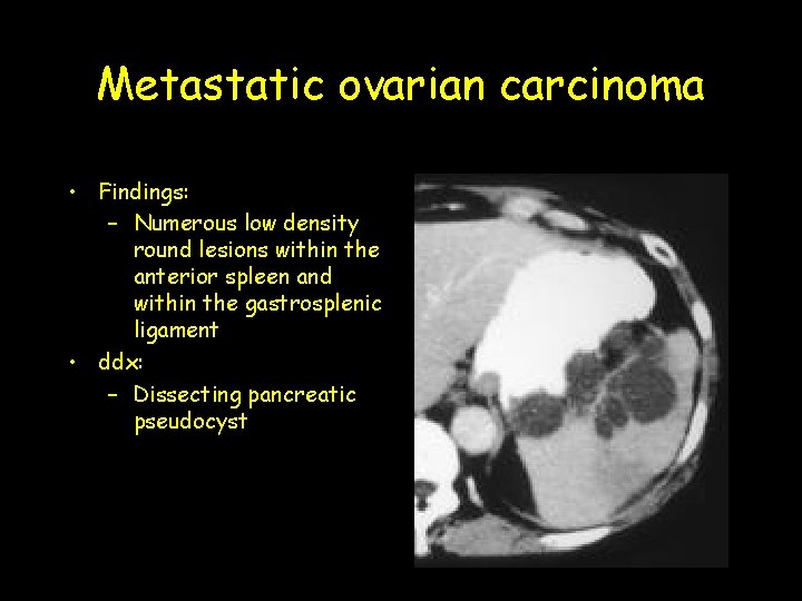 Metastatic ovarian carcinoma • Findings: – Numerous low density round lesions within the anterior