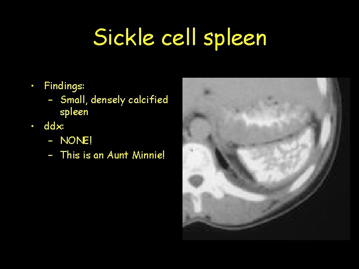 Sickle cell spleen • Findings: – Small, densely calcified spleen • ddx: – NONE!
