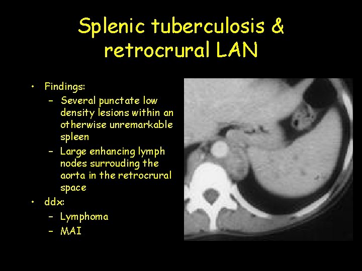 Splenic tuberculosis & retrocrural LAN • Findings: – Several punctate low density lesions within
