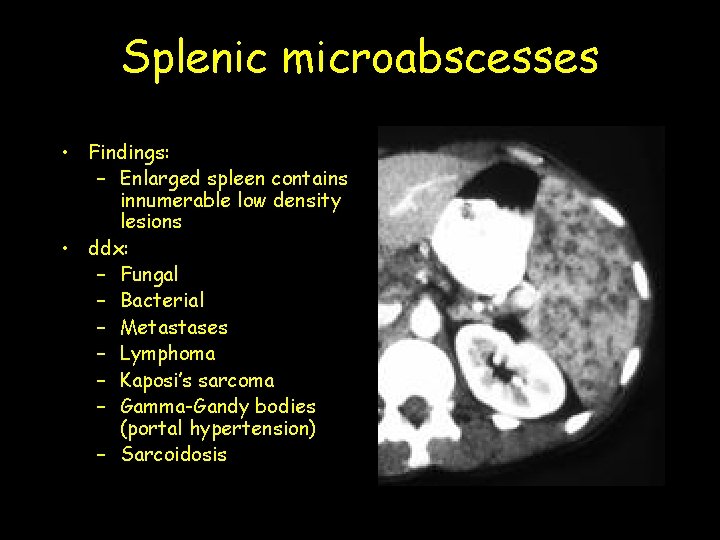 Splenic microabscesses • Findings: – Enlarged spleen contains innumerable low density lesions • ddx: