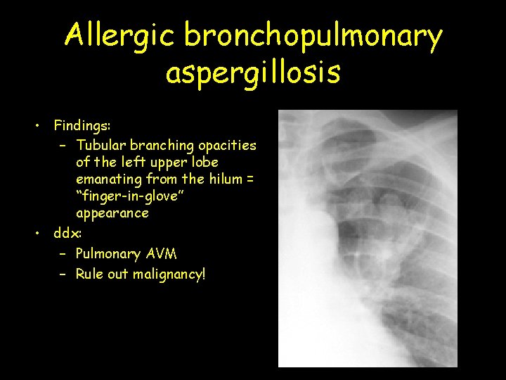 Allergic bronchopulmonary aspergillosis • Findings: – Tubular branching opacities of the left upper lobe