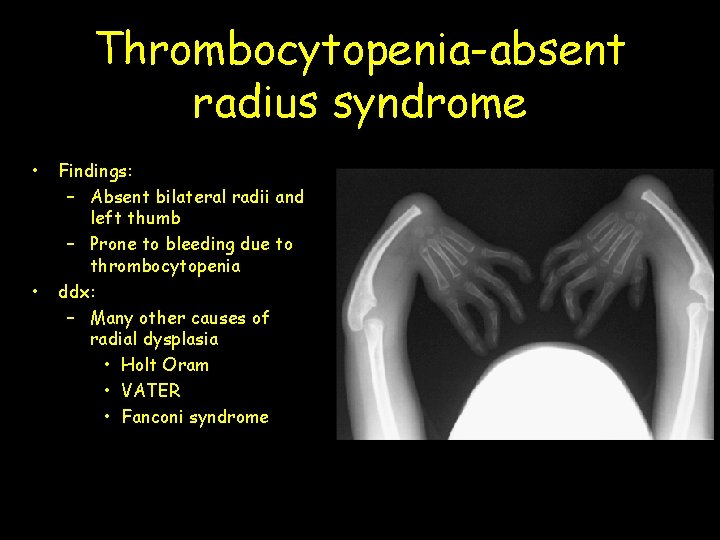 Thrombocytopenia-absent radius syndrome • • Findings: – Absent bilateral radii and left thumb –