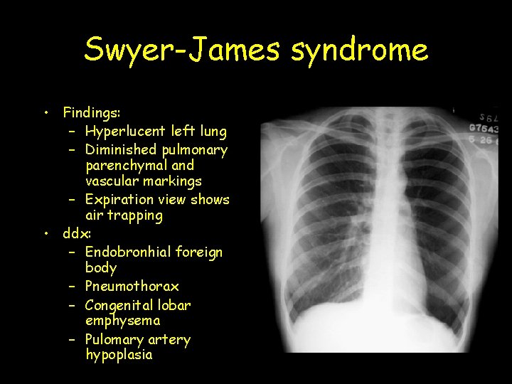 Swyer-James syndrome • Findings: – Hyperlucent left lung – Diminished pulmonary parenchymal and vascular