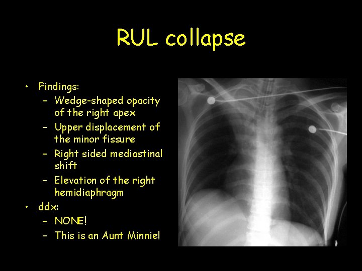 RUL collapse • Findings: – Wedge-shaped opacity of the right apex – Upper displacement