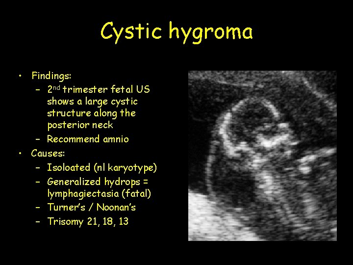 Cystic hygroma • Findings: – 2 nd trimester fetal US shows a large cystic