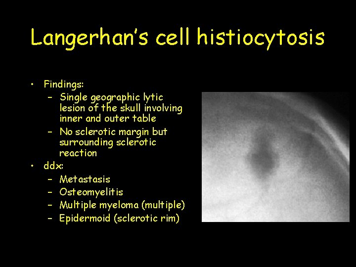 Langerhan’s cell histiocytosis • Findings: – Single geographic lytic lesion of the skull involving