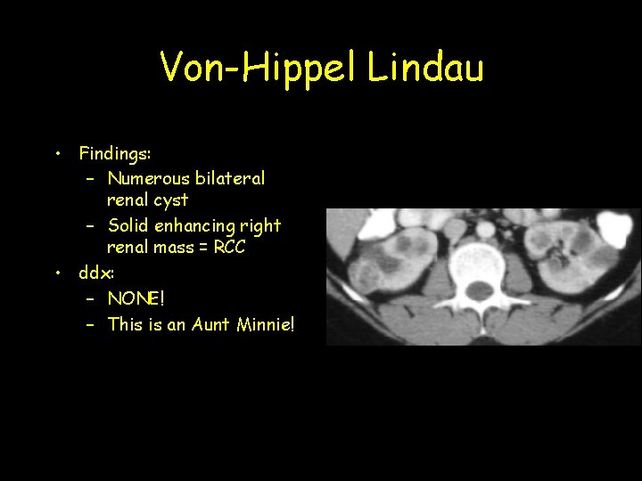 Von-Hippel Lindau • Findings: – Numerous bilateral renal cyst – Solid enhancing right renal