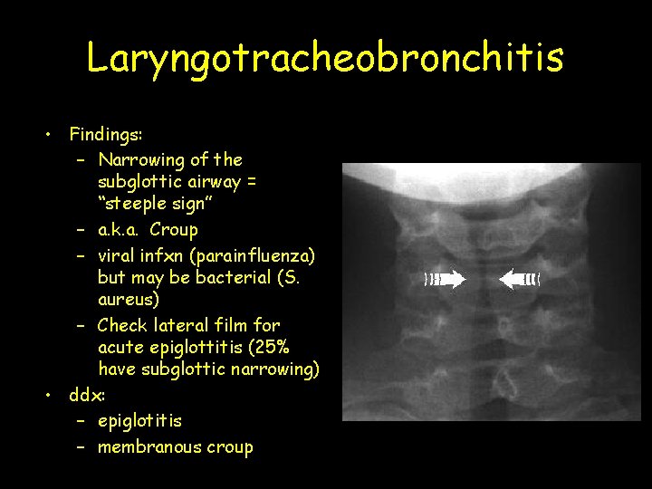 Laryngotracheobronchitis • Findings: – Narrowing of the subglottic airway = “steeple sign” – a.