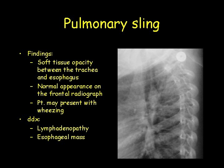 Pulmonary sling • Findings: – Soft tissue opacity between the trachea and esophagus –