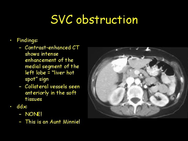 SVC obstruction • Findings: – Contrast-enhanced CT shows intense enhancement of the medial segment