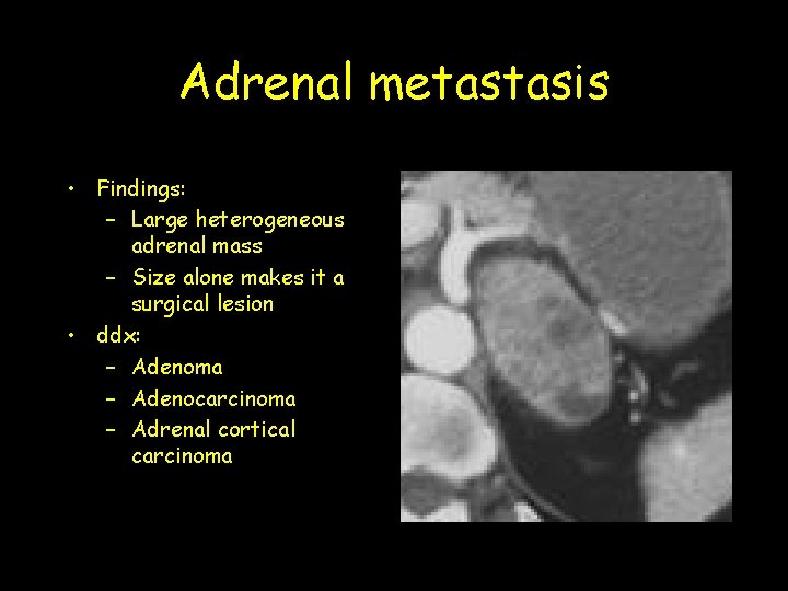 Adrenal metastasis • Findings: – Large heterogeneous adrenal mass – Size alone makes it