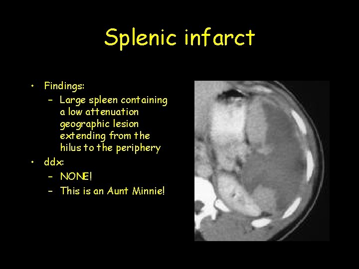 Splenic infarct • Findings: – Large spleen containing a low attenuation geographic lesion extending