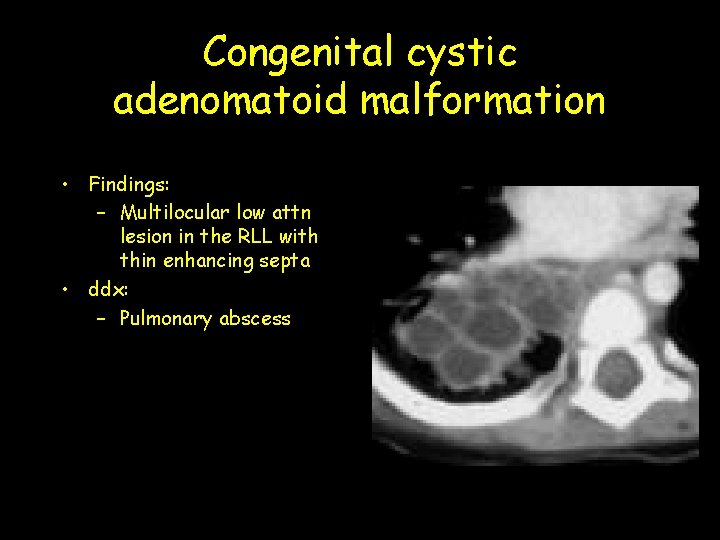 Congenital cystic adenomatoid malformation • Findings: – Multilocular low attn lesion in the RLL