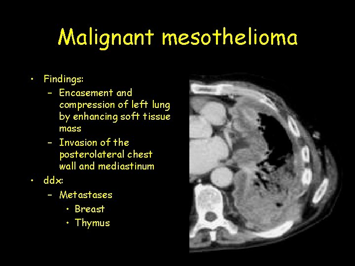 Malignant mesothelioma • Findings: – Encasement and compression of left lung by enhancing soft