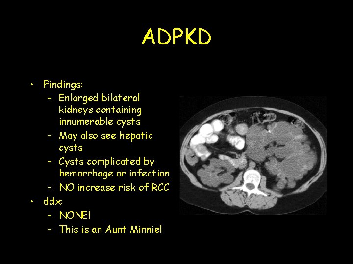 ADPKD • Findings: – Enlarged bilateral kidneys containing innumerable cysts – May also see
