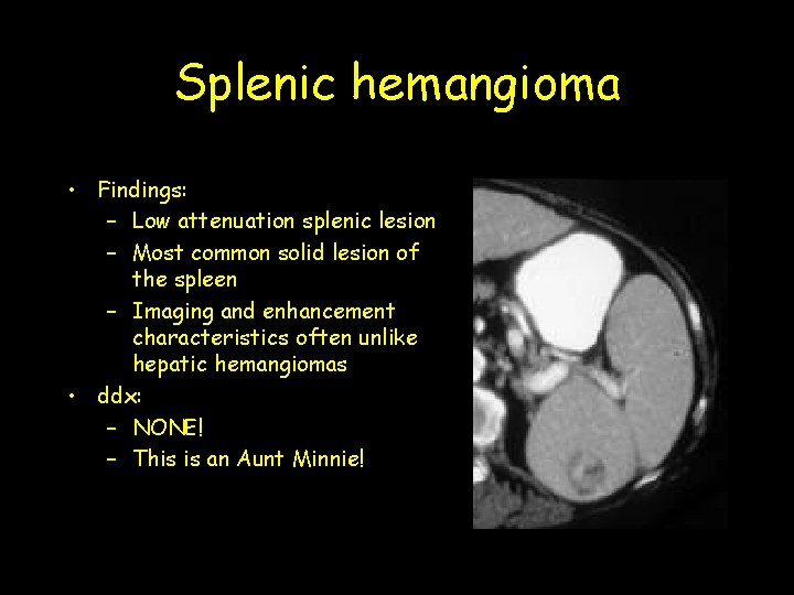 Splenic hemangioma • Findings: – Low attenuation splenic lesion – Most common solid lesion