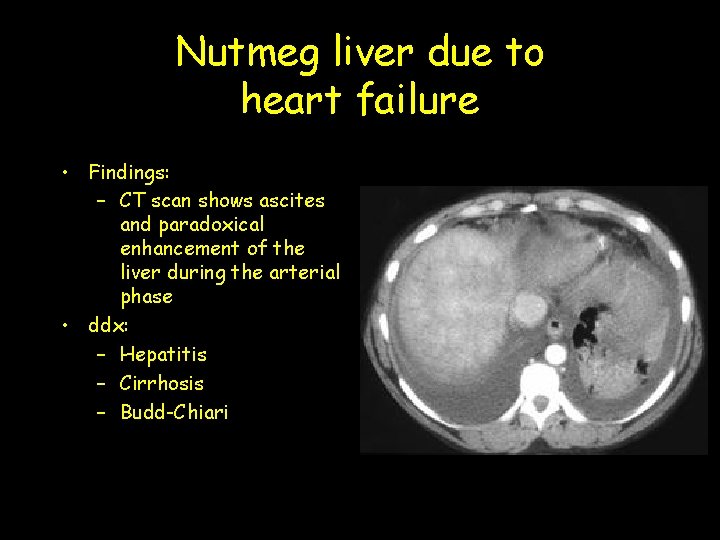 Nutmeg liver due to heart failure • Findings: – CT scan shows ascites and