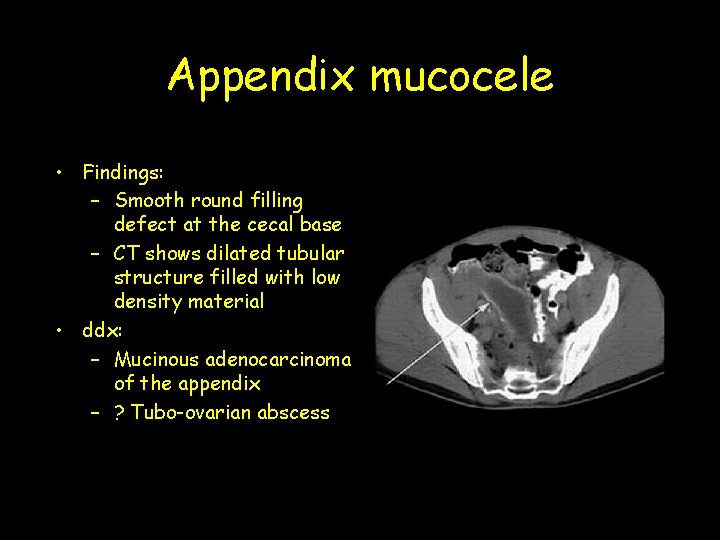 Appendix mucocele • Findings: – Smooth round filling defect at the cecal base –
