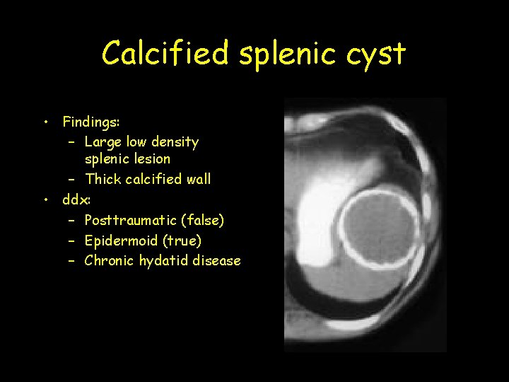 Calcified splenic cyst • Findings: – Large low density splenic lesion – Thick calcified