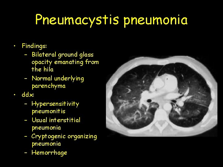 Pneumacystis pneumonia • Findings: – Bilateral ground glass opacity emanating from the hila –
