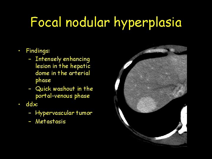 Focal nodular hyperplasia • Findings: – Intensely enhancing lesion in the hepatic dome in