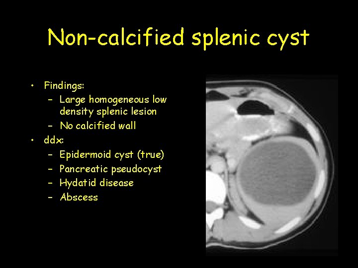 Non-calcified splenic cyst • Findings: – Large homogeneous low density splenic lesion – No