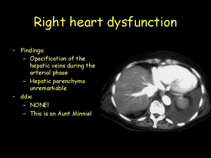 Right heart dysfunction • Findings: – Opacification of the hepatic veins during the arterial