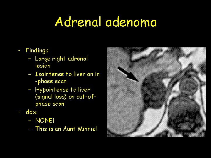 Adrenal adenoma • Findings: – Large right adrenal lesion – Isointense to liver on