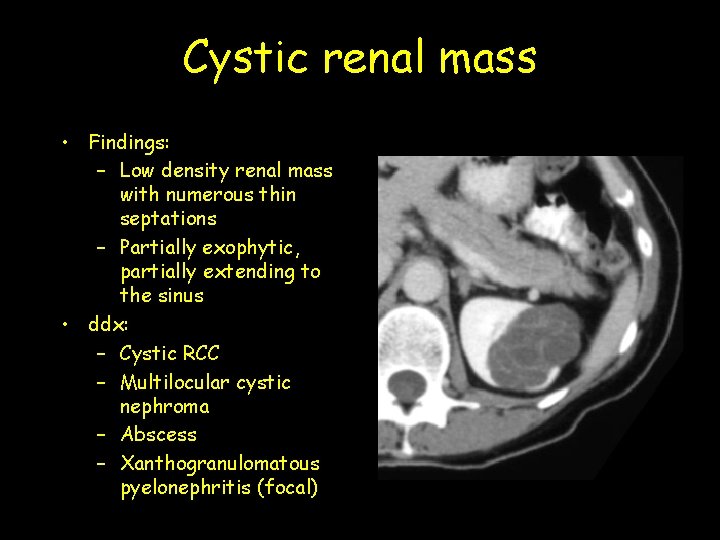 Cystic renal mass • Findings: – Low density renal mass with numerous thin septations