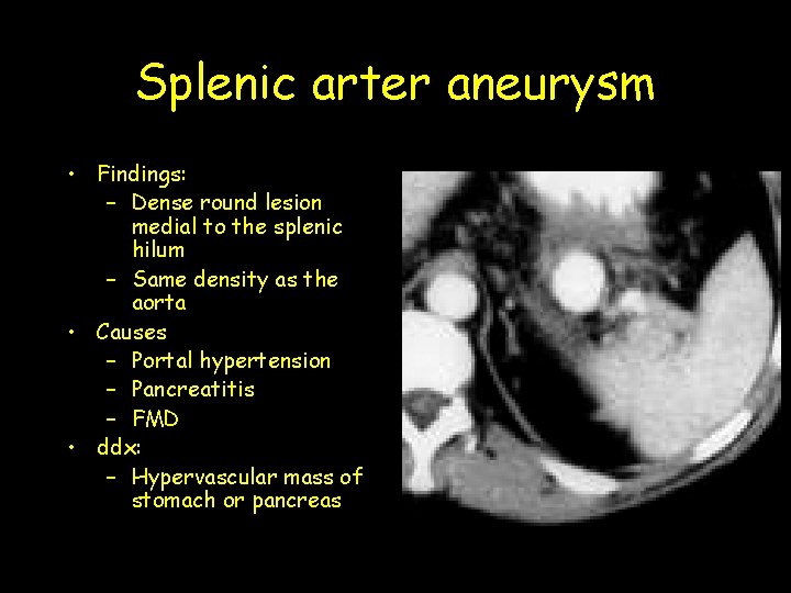 Splenic arter aneurysm • Findings: – Dense round lesion medial to the splenic hilum