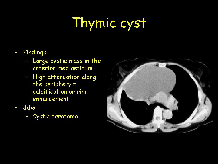 Thymic cyst • Findings: – Large cystic mass in the anterior mediastinum – High