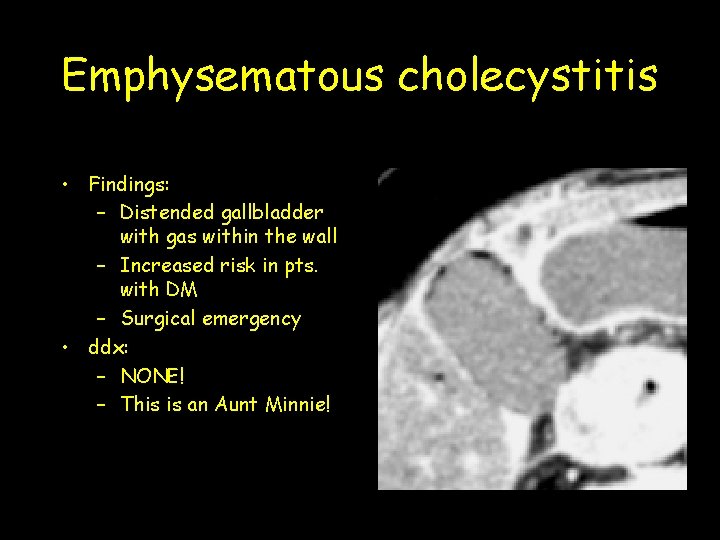 Emphysematous cholecystitis • Findings: – Distended gallbladder with gas within the wall – Increased