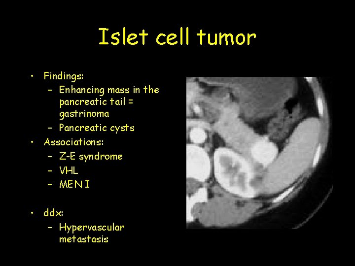 Islet cell tumor • Findings: – Enhancing mass in the pancreatic tail = gastrinoma