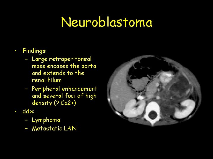 Neuroblastoma • Findings: – Large retroperitoneal mass encases the aorta and extends to the
