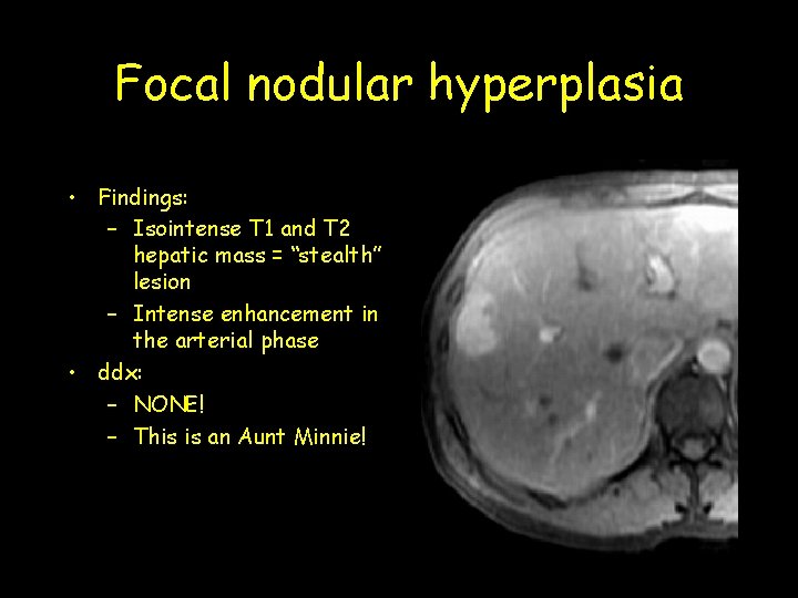 Focal nodular hyperplasia • Findings: – Isointense T 1 and T 2 hepatic mass
