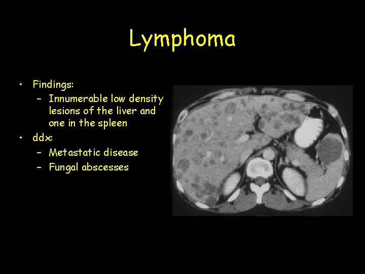 Lymphoma • Findings: – Innumerable low density lesions of the liver and one in