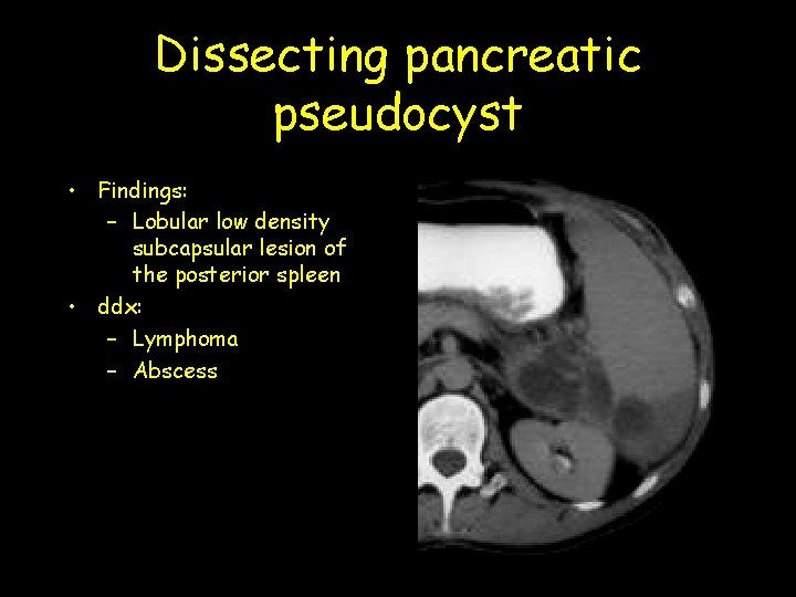 Dissecting pancreatic pseudocyst • Findings: – Lobular low density subcapsular lesion of the posterior