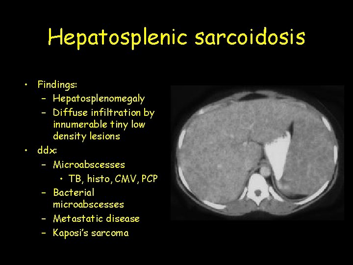 Hepatosplenic sarcoidosis • Findings: – Hepatosplenomegaly – Diffuse infiltration by innumerable tiny low density