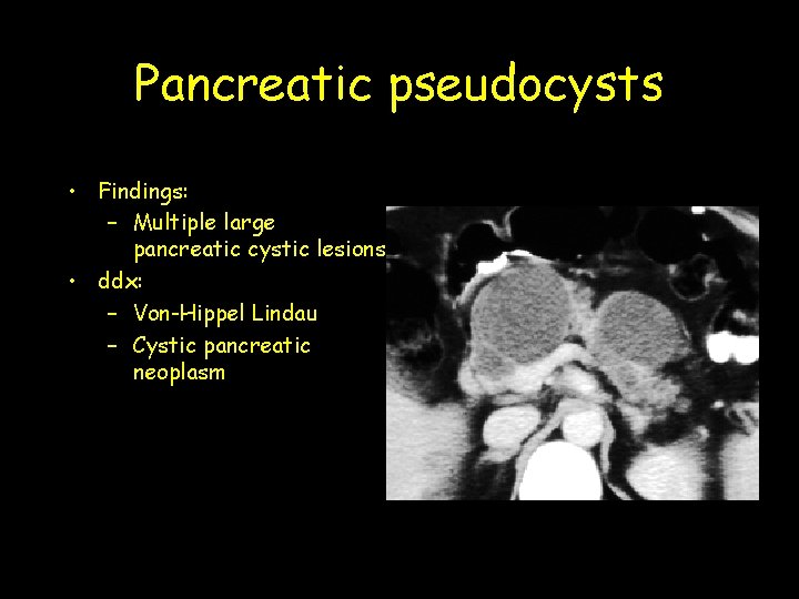 Pancreatic pseudocysts • Findings: – Multiple large pancreatic cystic lesions • ddx: – Von-Hippel