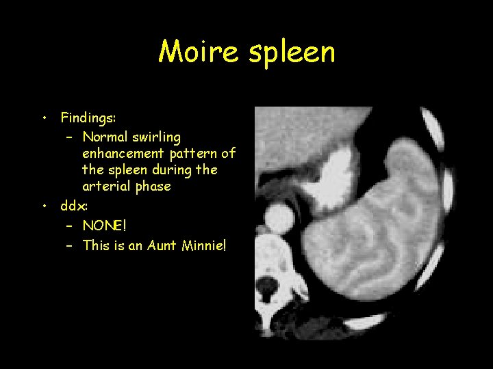 Moire spleen • Findings: – Normal swirling enhancement pattern of the spleen during the